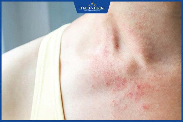 sản phẩm dưỡng ẩm giúp giảm chàm